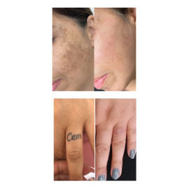 Derma Rays Rapido+ Picosecond Laser with PTP Technology